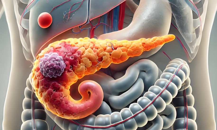 文献解读|Cancer Cell（44.5）：胰腺导管内乳头状肿瘤的多组学分析揭